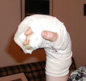 hand in cast