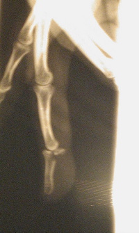 xray of hand